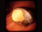 images/thumbs/Fall1Gastroduodenoskopie.png