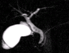 images/thumbs/Fall1MRCP.png