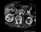 images/thumbs/Fall2Computertomografie.png