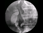 images/thumbs/Fall2ERCP.png