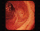 images/thumbs/Fall2Gastroduodenoskopie.png