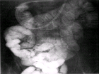images/thumbs/Fall2MaDaPaNormalbefund.png