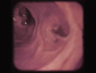 images/thumbs/Fall3Gastroduodenoskopie.png
