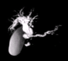 images/thumbs/Fall3MRCP.png