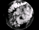 images/thumbs/Fall3MaDaPaNormalbefund.png