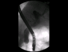 images/thumbs/Fall4ERCP.png