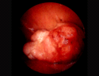 images/thumbs/Fall4Gastroduodenoskopie.png