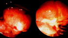 images/thumbs/Fall5Gastroduodenoskopie.png